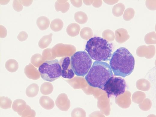 Giemsa-stained Peripheral Blood Smear (High Power).