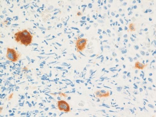 CD61 Immunostain on Bone Marrow Core Biopsy for Megakaryocytes