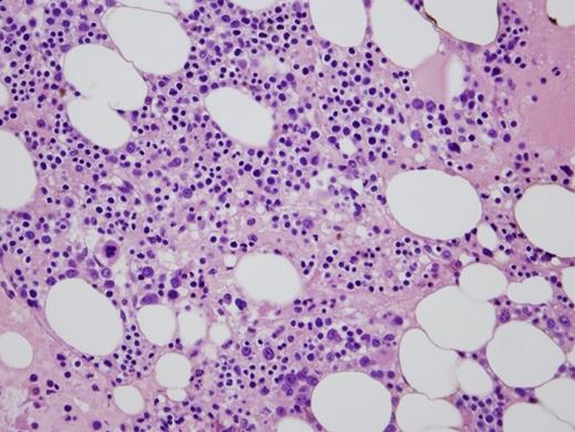 Bone marrow biopsy. / Bone marrow biopsy.
