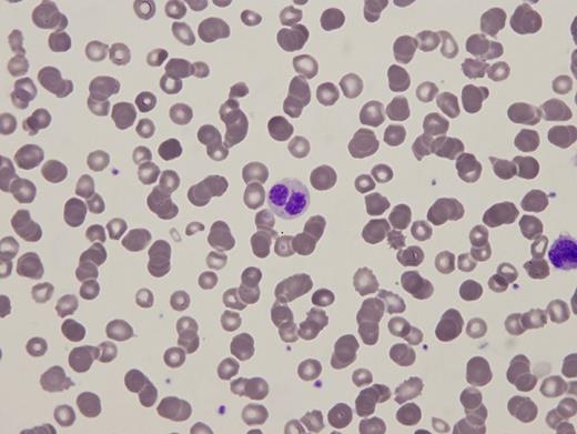 Peripheral blood smear. / Peripheral blood smear Part A.