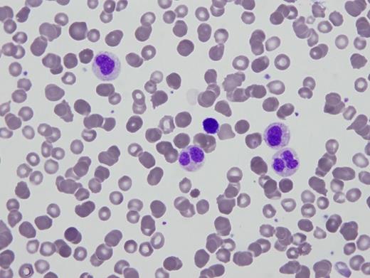 Peripheral blood smear. / Peripheral blood smear Part B.