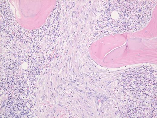 Hematoxylin and eosin–stained core biopsy of bone marrow.