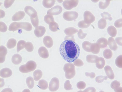 Peripheral blood, Wright stain.