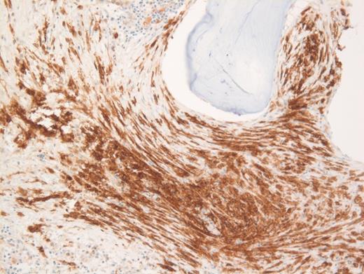 CD117 immunohistochemical stain on core biopsy.