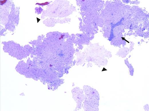 Low-power pathologic image showing fragments of brain tissue with areas of necrosis (arrowheads), as well as a patchy lymphoid infiltrate, including distinctly perivascular infiltrates (arrow).