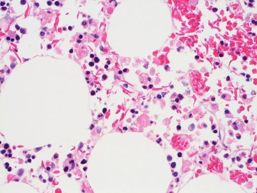 Focal areas of marrow damage shown in core biopsy.