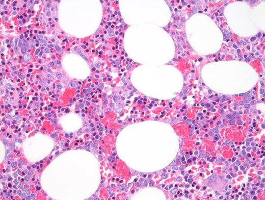 "Hypercellular marrow shown in core biopsy.