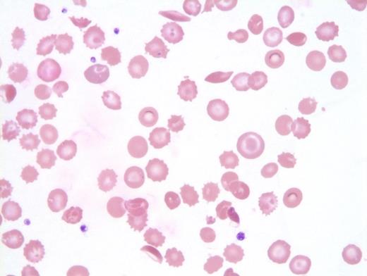 Abnormal red cell findings in peripheral blood.