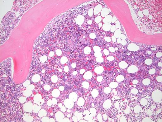 Hypercellular marrow shown in core biopsy.