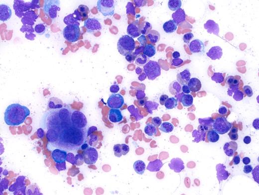 Trilineage hematopoiesis with erythroid predominance.