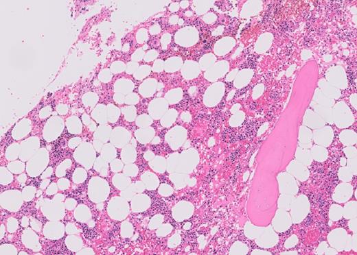 Bone marrow core biopsy with H&E staining.