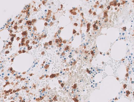 CD11c immunohistochemistry on core biopsy.