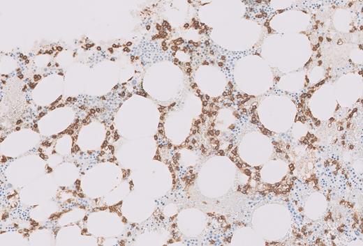 CD20 immunohistochemistry on core biopsy.