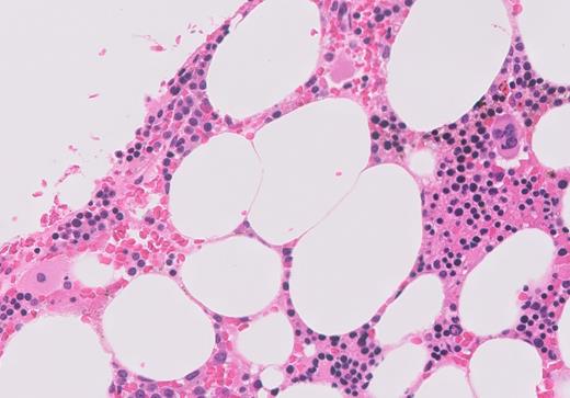 Bone marrow core biopsy with H&E staining.