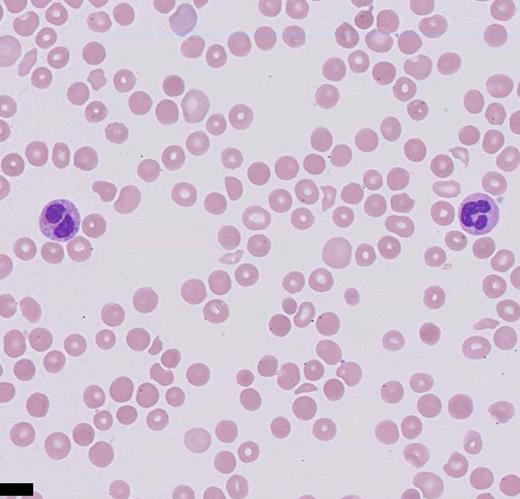 Giemsa-stained peripheral blood smear (high power).