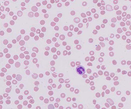 Giemsa-stained peripheral blood smear.
