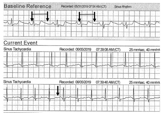 The top tracing is the topical patch monitor baseline reference several weeks after the sudden death event. The pairs of arrows indicate the QT interval. The bottom tracing shows persistent QT prolongation with a later tracing since the end of the QT segment is more than 50 percent of the R-R interval.