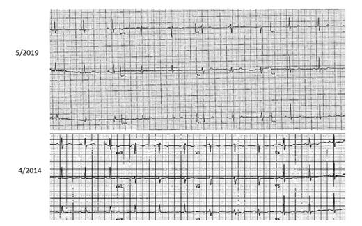 The current electrocardiogram (ECG) on top (May 2019) after ibrutinib is withheld for at least two weeks. The ECG on the bottom (April 2014) precedes the initiation of ibrutinib initially. No significant changes are noted between these two tracings.