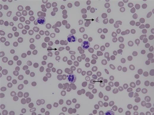 Peripheral blood smear before treatment (magnification x600)