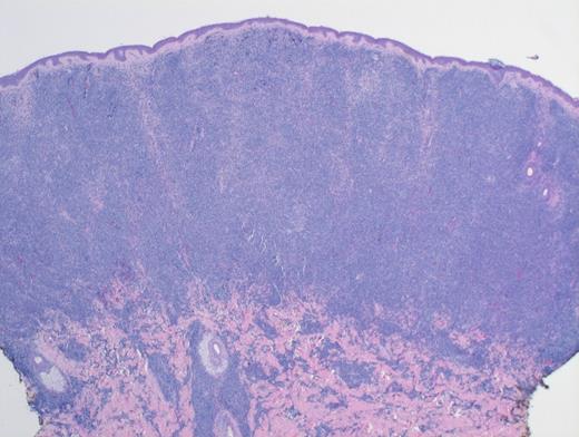 Low-Power H&E. Extensive, monotonous infiltrate composed of small- to medium-sized cells extending into the dermis. The epidermis is not involved (magnification x400).