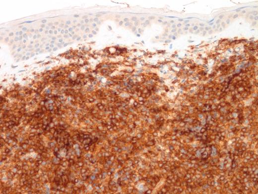 CD123 Immunostain (magnification x400).