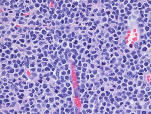 High-Power H&E. High-power demonstrates blastoid medium-sized lymphoid cells with dispersed chromatin (magnification x100).