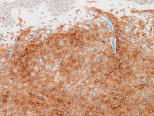 CD4 Immunostain (magnification x400).