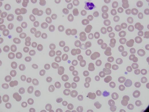 Patient 2 peripheral smear.