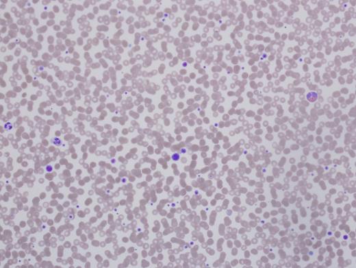 Patient 1 peripheral smear.