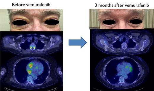 Photos showing manifestations of BRAF-V600E Erdheim-Chester disease in patient before and after treatment