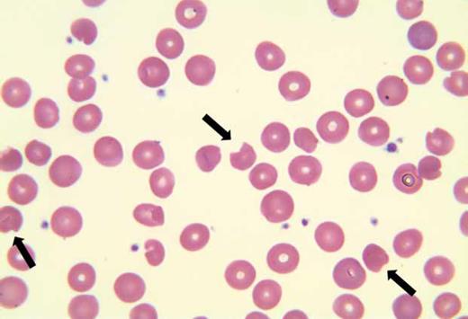 Peripheral blood smear for Bite Cells Abound image challenge. / Peripheral blood smear.
