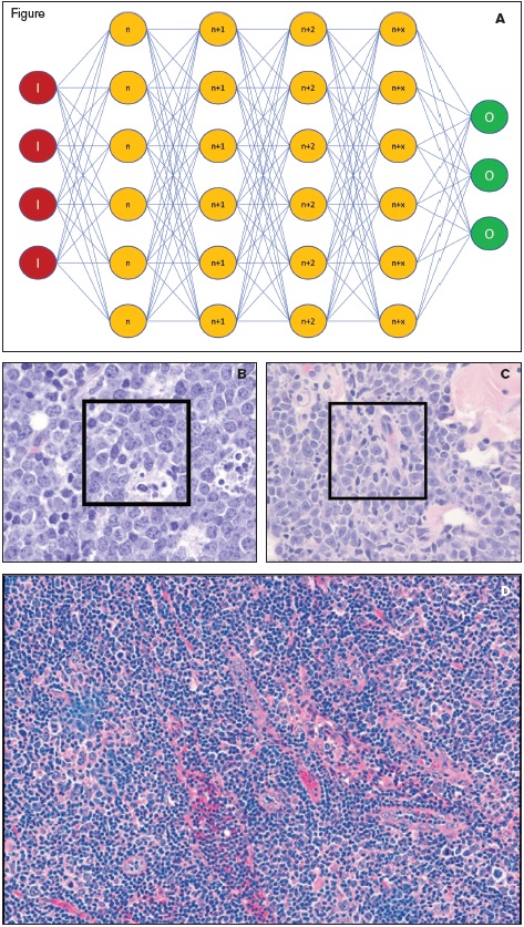 (A) Schematic of a convolutional neural network (CNN) with input (red circles marked with an “I”), multiple hidden layers of the network (orange circles representing layers n through n+x, where x is the number of layers and was 82 in the optimal CNN), and the output (green circles marked with an “O”). (B and C) Images of Burkitt lymphoma (B) and diffuse large B-cell lymphoma (C) with subcroppings used for input data for the training of the CNN indicated by the black box insets (reprinted with permission from the ASH Image Bank). (D) An example of an image of DLBCL that was diagnosed incorrectly as BL due to the large number of infiltrating small lymphocytes (reprinted with permission from Mohlman JS et al. Improving augmented human intelligence to distinguish Burkitt lymphoma from diffuse large B-cell lymphoma cases. Am J Clin Pathol, 2020; doi:10.1093/ajcp/aqaa001).
