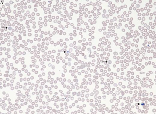 Peripheral blood smear in intramedullary hemolysis in myelodysplastic syndromes image challenge. / Peripheral blood smear.