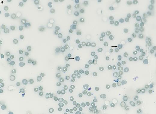 Manual supravital staining of peripheral blood smear at 60 x magnification. / Manual supravital staining of PB smear.