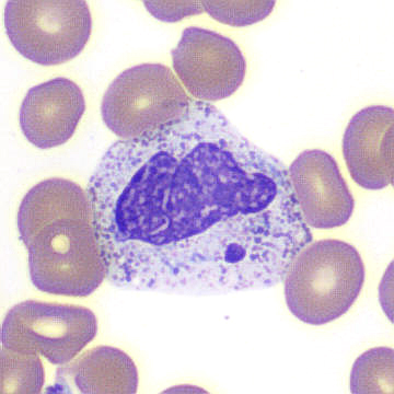 Peripheral blood smear. / Peripheral blood smear.