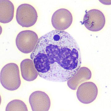 Peripheral blood smear. / Peripheral blood smear.