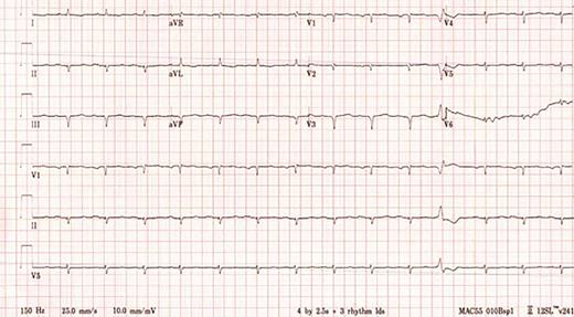A 12-lead electrocardiogram showing sinus rhythm with Q waves in the anteroseptal and inferior leads as well as markedly low QRS voltage, particularly in the limb leads.