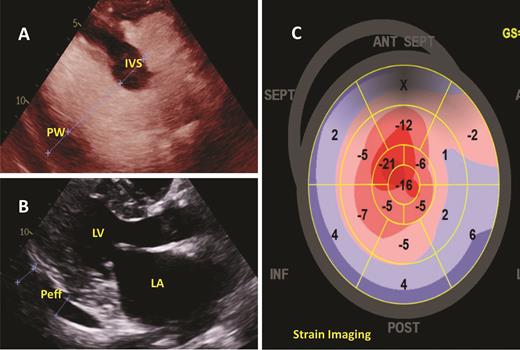 Two-dimensional transthoracic echocardiogram demonstrating the following: (A) Measuring the interventricular septal (IVS) and posterior wall (PW) thickness, both of which were determined to meet criteria for left ventricular hypertrophy; (B) Parasternal long axis view demonstrating the left ventricle (LV), left atrium (LA), and a small to moderate, posterior pericardial effusion (Peff); (C) strain imaging showing apical sparing, which has been associated with cardiac amyloidosis.