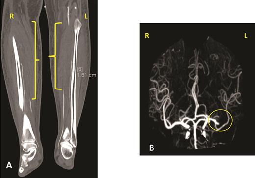 Panel A shows one of the views of a computed tomography angiogram of the lower extremities. The yellow brackets indicate areas of stenosis or occlusion in both lower extremities. The patient was found to have an occluded right popliteal artery, right anterior and posterior tibial artery, right tibioperoneal trunk, and right and left peroneal artery. She had different degrees of occlusion in those vessels. Panel B shows a cerebral angiogram, with the yellow circle indicating the occlusion of the proximal inferior left M2 branch.