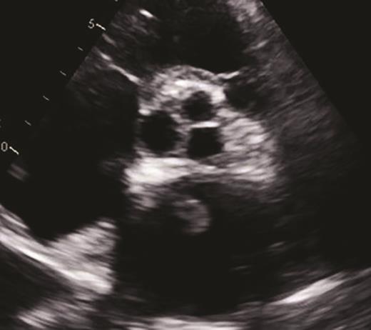 Short-axis view of a two-dimensional transthoracic echocardiogram demonstrating a new 1.5 × 1.0 cm echodensity (yellow circle) in the left atrium. This is compelling evidence by echocardiography indicating a thrombus.