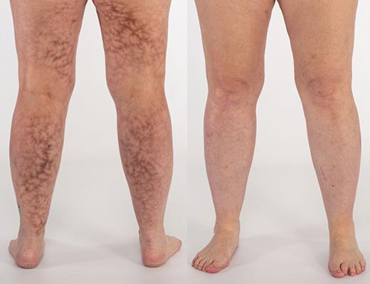 Skin rash in patient