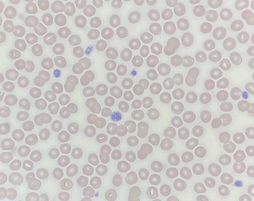 Peripheral blood smear.