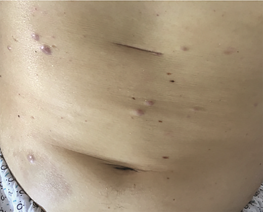 Nontender purple papules on the chest and abdomen in Case 1.
