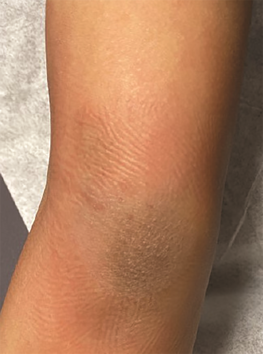 Right medial elbow with a large tender purple plaque in Case 2.