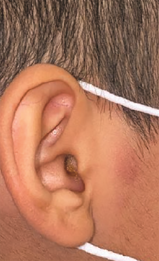 Purple-blue nodule on right preauricular cheek in Case 2.
