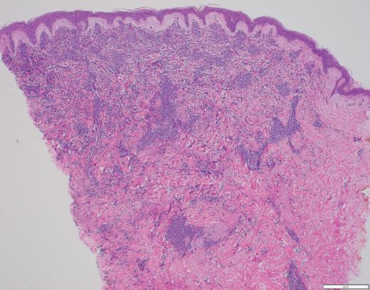 Case 1 histopathology showing mononuclear cells extending from the epidermis to the base of the specimen with an interstitial pattern present between and among collagen bundles along with scattered mitotic figures. (A) Hematoxylin and eosin stain (2×); (B) hematoxylin and eosin stain (40×).
