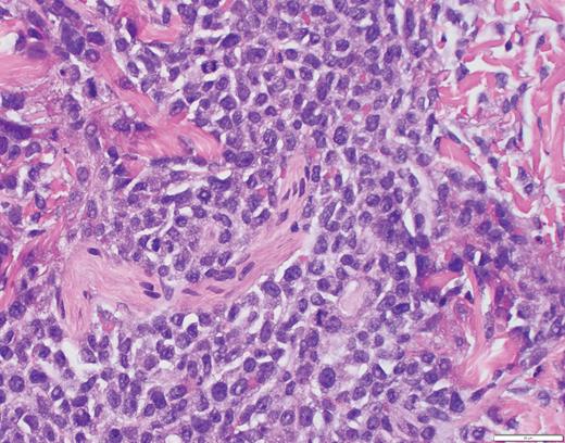 Case 1 histopathology showing mononuclear cells extending from the epidermis to the base of the specimen with an interstitial pattern present between and among collagen bundles along with scattered mitotic figures. (A) Hematoxylin and eosin stain (2×); (B) hematoxylin and eosin stain (40×).