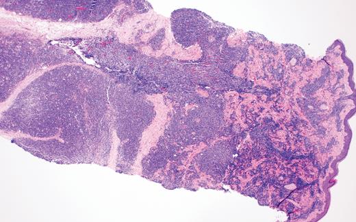 Case 2 histopathology showing dense atypical infiltrate composed of medium-size cells with irregular nuclear contours, fine chromatin, and scant cytoplasm, resembling undifferentiated blast cells with frequent mitoses and scattered admixed foamy macrophages, some with hemosiderin diffusely involving the dermis. (A) Hematoxylin and eosin stain (2×); (B) hematoxylin and eosin stain (40×).