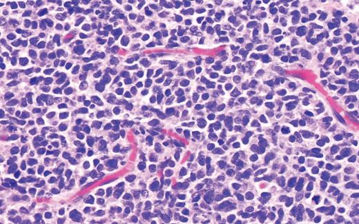 Case 2 histopathology showing dense atypical infiltrate composed of medium-size cells with irregular nuclear contours, fine chromatin, and scant cytoplasm, resembling undifferentiated blast cells with frequent mitoses and scattered admixed foamy macrophages, some with hemosiderin diffusely involving the dermis. (A) Hematoxylin and eosin stain (2×); (B) hematoxylin and eosin stain (40×).