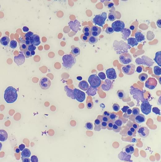 Bone marrow aspirate.